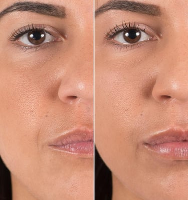 dermal filler results