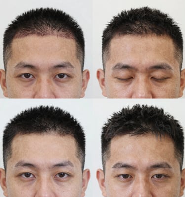 Before and after comparison of a male hair transplant result showing a restored frontal hairline.