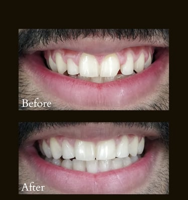 Bleeding gums treatment and Ceramic Veneers by Gums Specialist near Goregaon Mumbai