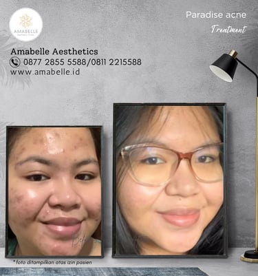 amabelle before after anti acne treatment