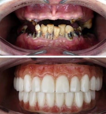All-on-4-dental-implants