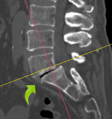 Espondilolistesi lumbar, listesis anterior, dr tafur, artrodesis lumbar