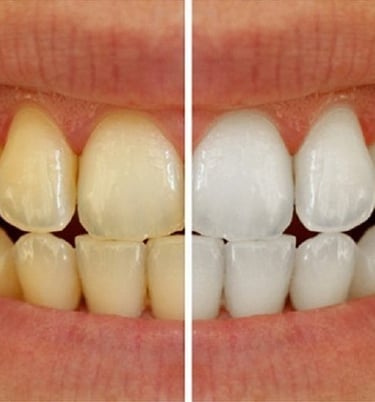 Teeth Cleaning and whitening at dentosculpt
