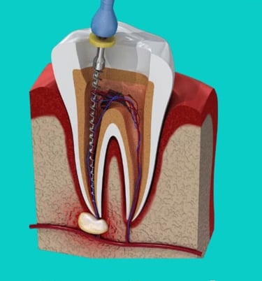 Root canal Treatment at dentosculpt
