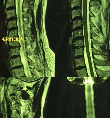 cervical MRI after Discogel injection for severe disc hernition