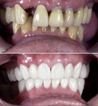 Dental Crowns hollywood smile