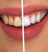 Zahnbleaching