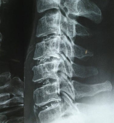 Multi level Discogel injection for cervical disc herniations