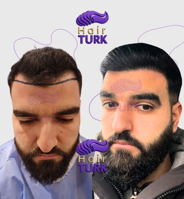 Patient result 12 months after a 3500 graft DHI hair transplant