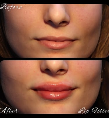 lip filler before after photos in Antalya