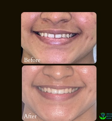 Teeth straightening with invisible braces like invisalign aligners by top orthodontist in Malad