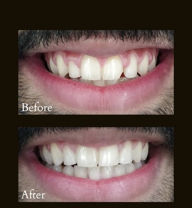 Bleeding gums treatment and Ceramic Veneers by Gums Specialist near Goregaon Mumbai