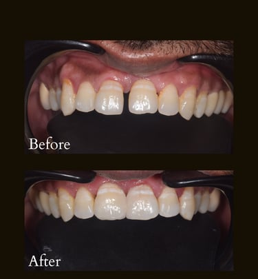 Teeth gap closure with Invisalign invisible braces and aligners done by best cosmetic dentist near Malad West in Mumbai