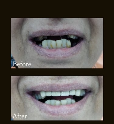 Ceramic Caps with dental implants used for replacing missing front teeth giving beautiful smile