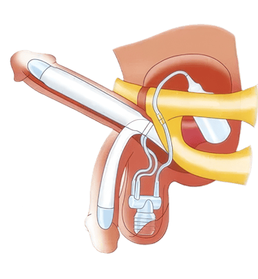 دعامة العضو الذكرى