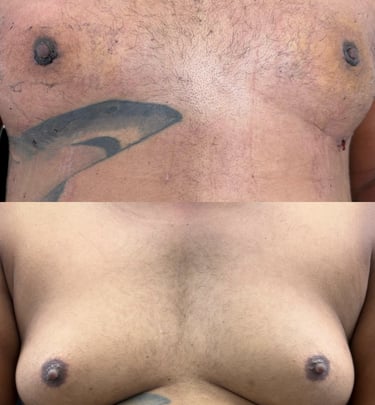 Ginecomastia - antes x depois