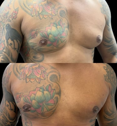 Ginecomastia - antes x depois