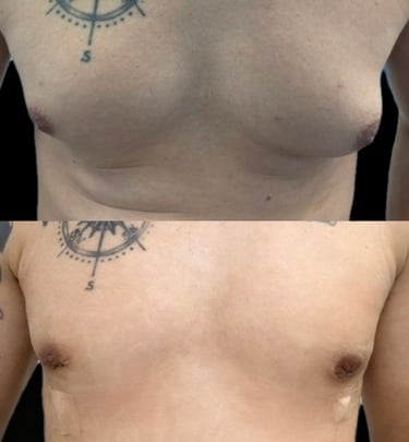 Ginecomastia - antes x depois