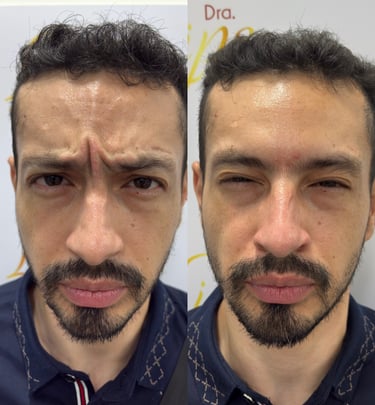 Botox para hombre San Jose Costa Rica