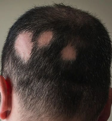Vadodara's best dermatologist offers alopecia treatment for bald patch, skin specialist