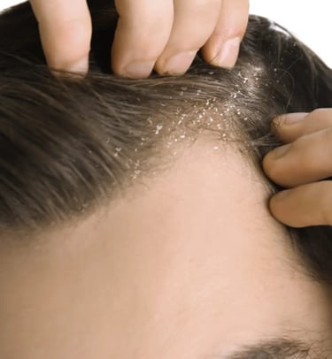 Top dermatologist in Vadodara offers effective dandruff treatment