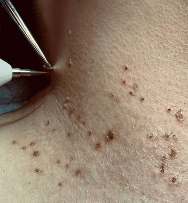 remover verrugas em bh