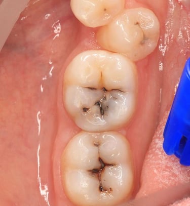 "how to make white teeth OralSurgery root canal price in mumbai WisdomTeeth"