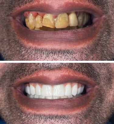 Snap on Dentures