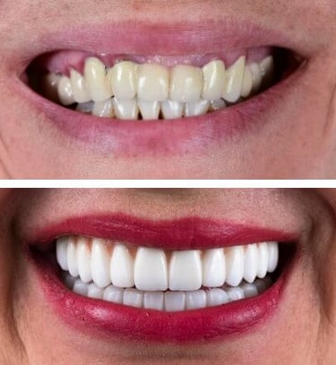 Smile makeover with veneers