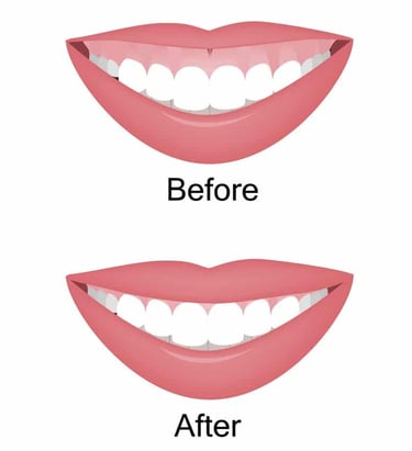 Gummy Smile Correction Treatment in Wadgaon Sheri