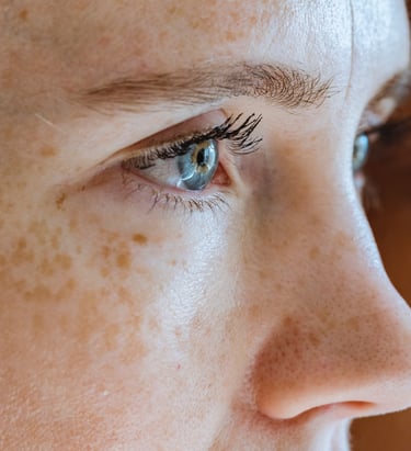 ojeras murcia laser ipl ojeras eliminación ojeras murcia tratamiendo acido hialuronico vitamina c