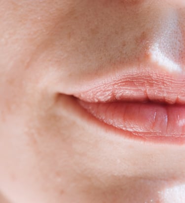 grosor labios aumento Acido Hialurónico botox flacidez estética