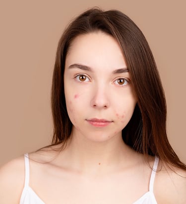 acné tratamiento láser hormonas topico oral formulas estética iMujer microneedling holistica peeling