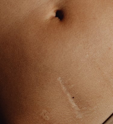 Tratamiento para eliminar la cicatrices en Murcia con láser CO2 fraccionado y peelings. iMujer