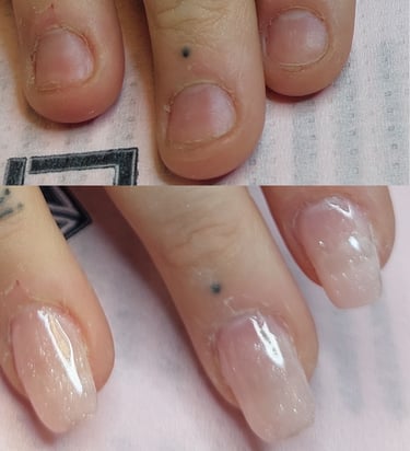 Behandling för nagelbitare