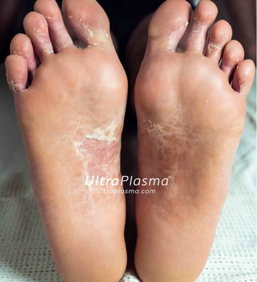 ultra_plasma_ultra_plazma_ultra-plasma_ultra-plazma_foot_fungus_ayak_mantari_tinea_pedis