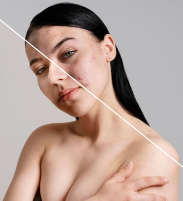 MIcroneedling skincare treatment comparison showing a woman's face with acne scars and clear skin.