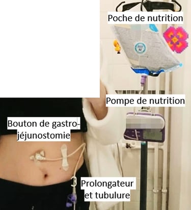 nutrition entérale