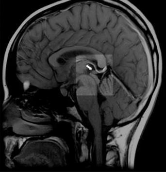 MRI scan of healthy normal pineal gland for meditation practice and spiritual wellness comparison"