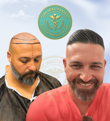 photo resultat de avant et apres l'implantation capillaire