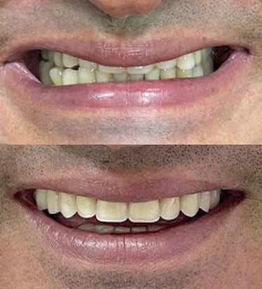 prótese dentária em Coqueiral de Itaparica