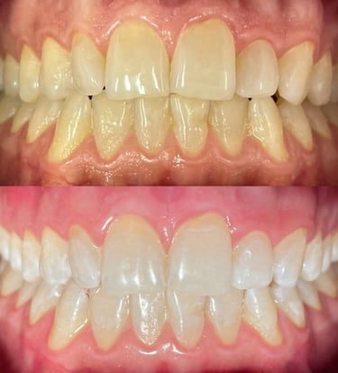 Clareamento de dente em Vila Velha