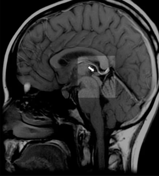 MRI scan of healthy normal pineal gland for meditation practice and spiritual wellness comparison"