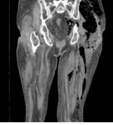 Necrotizing Fasciitis Flesh-Eating disease