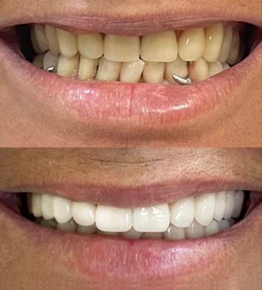 Implante de dente em Coqueiral de Itaparica