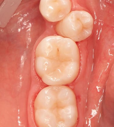 best oral surgeon near me , dental fillings, composite fillings, pailess root canal treatment "