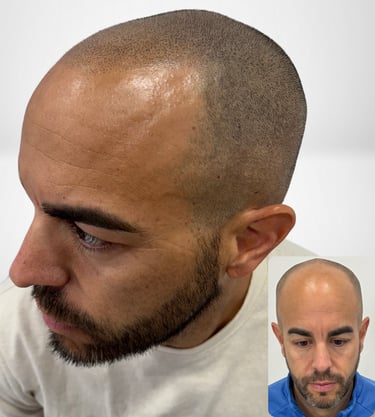 Resultados sorprendentes: Efecto densidad después de un injerto capilar. ¡Cabello más denso y natura