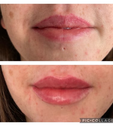Teoxane Lip Filler