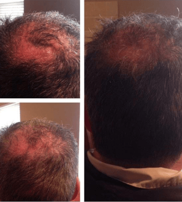 a man with a bald haircut and a bald