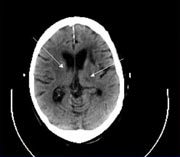 Brain MRI